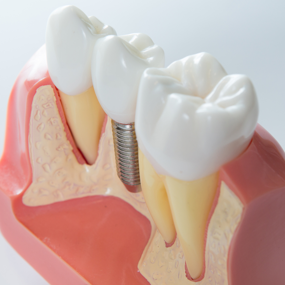 Los implantes dentales son duraderos en el tiempo si se cuidan bien.