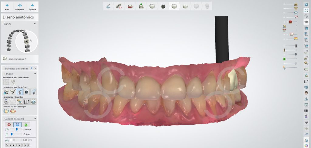 corona sobre implante odontologia digital 2